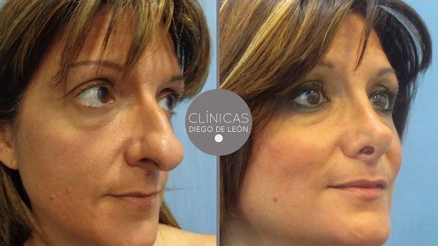 Rinoplastia Ana Isabel