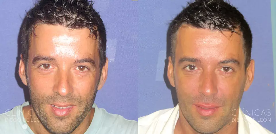 Antiarrugas y ácido hialurónico para hombres César