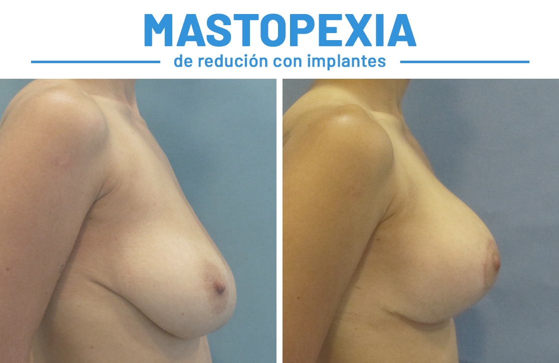 Mastopexia de reducción con implantes María