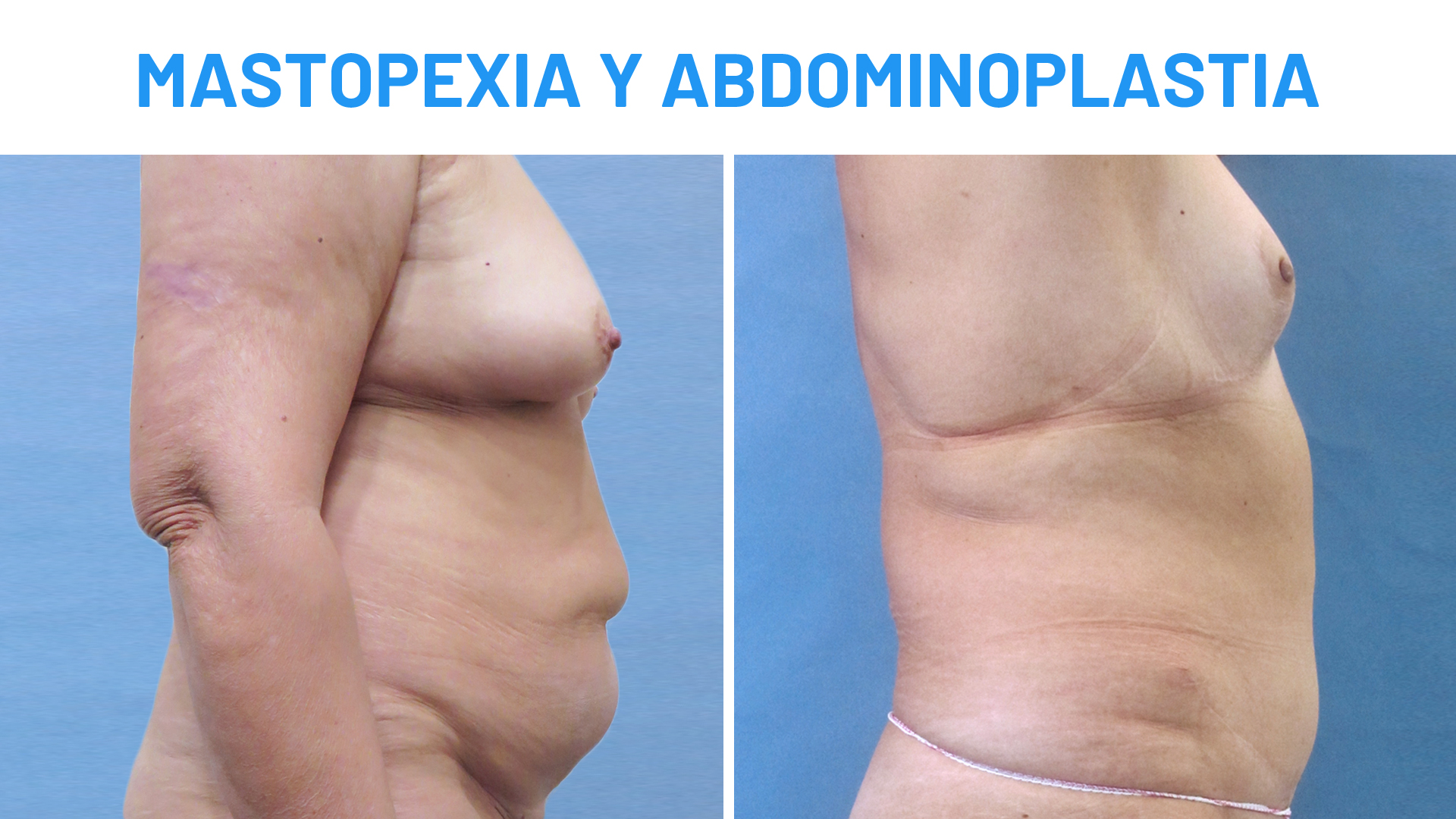 Mastopexia y Abdominoplastia: testimonio antes y después
