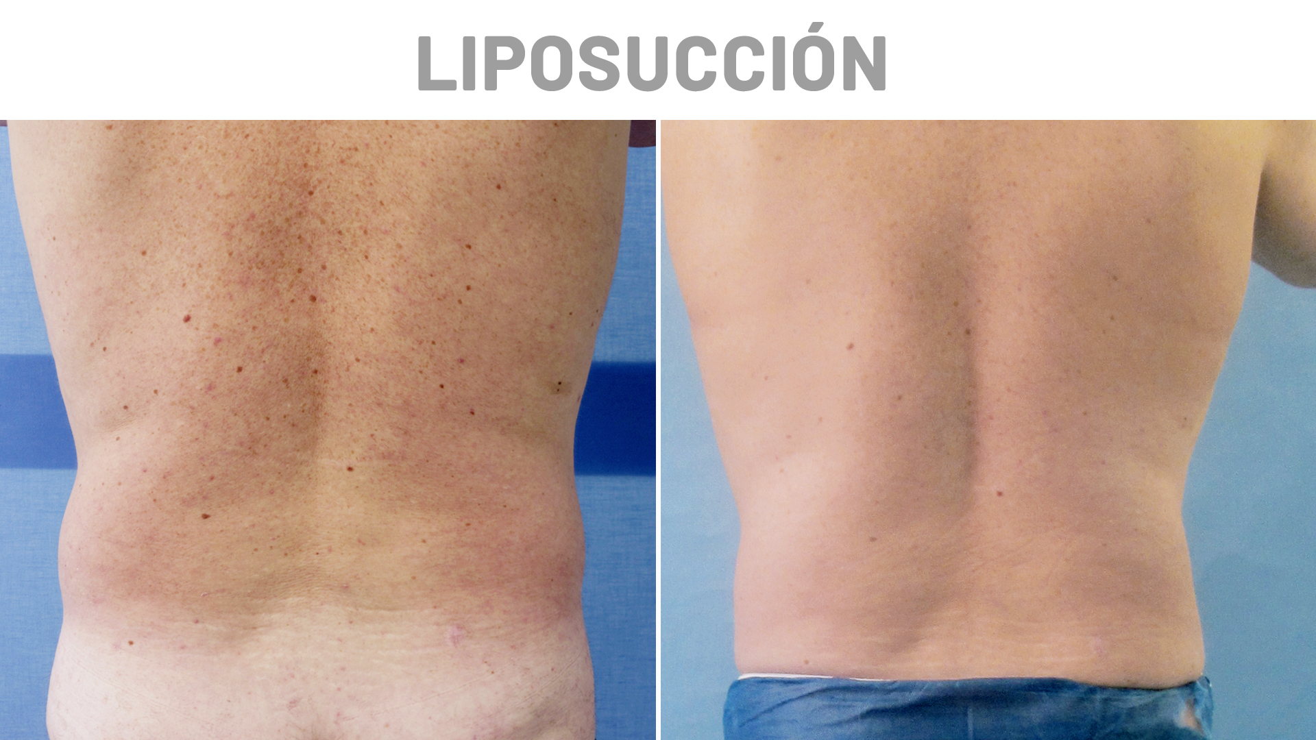 Liposucci n Masculina Resultados Cl nicas Diego De Le n Liposucci n Masculina Resultados Cl nicas Diego De Le n