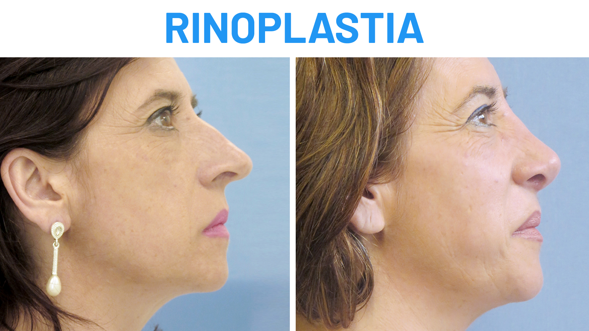 Rinoplastia resultados