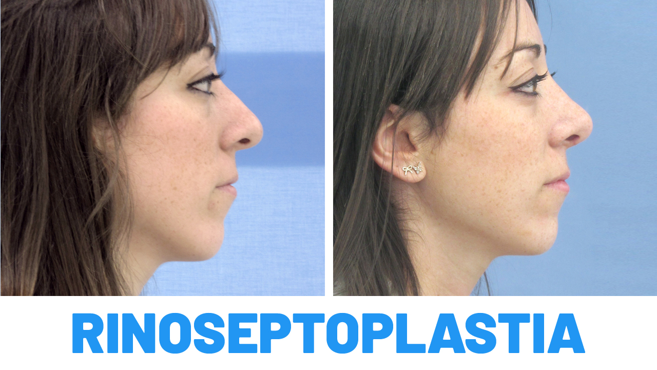 Rinoseptoplastia resultados