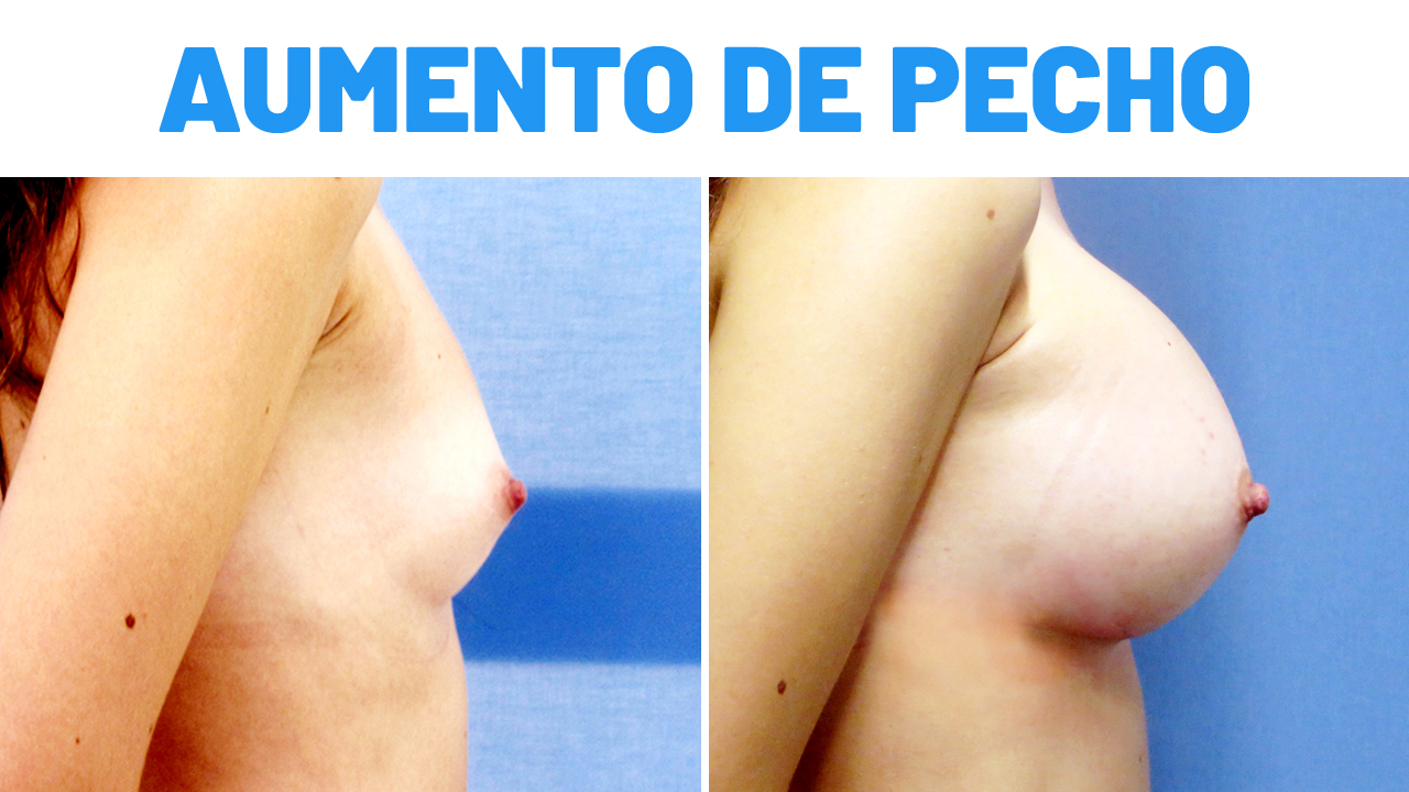 Resultados de aumento de senos