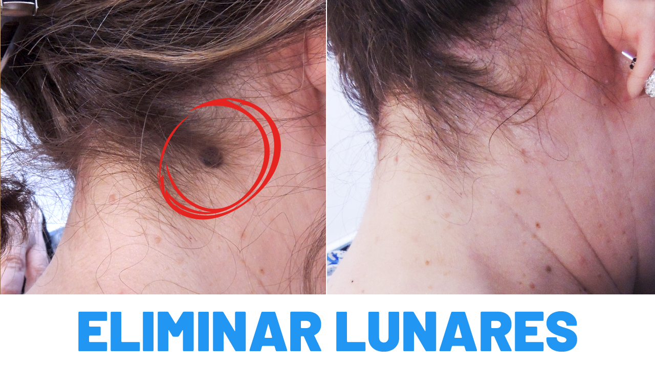 Eliminar lunares con láser CO2