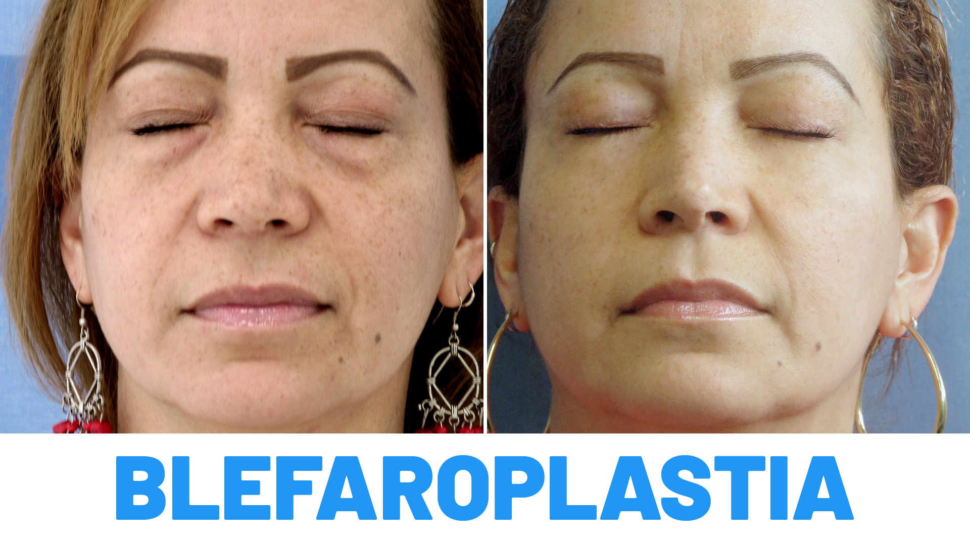 Blefaroplastia completa resultados