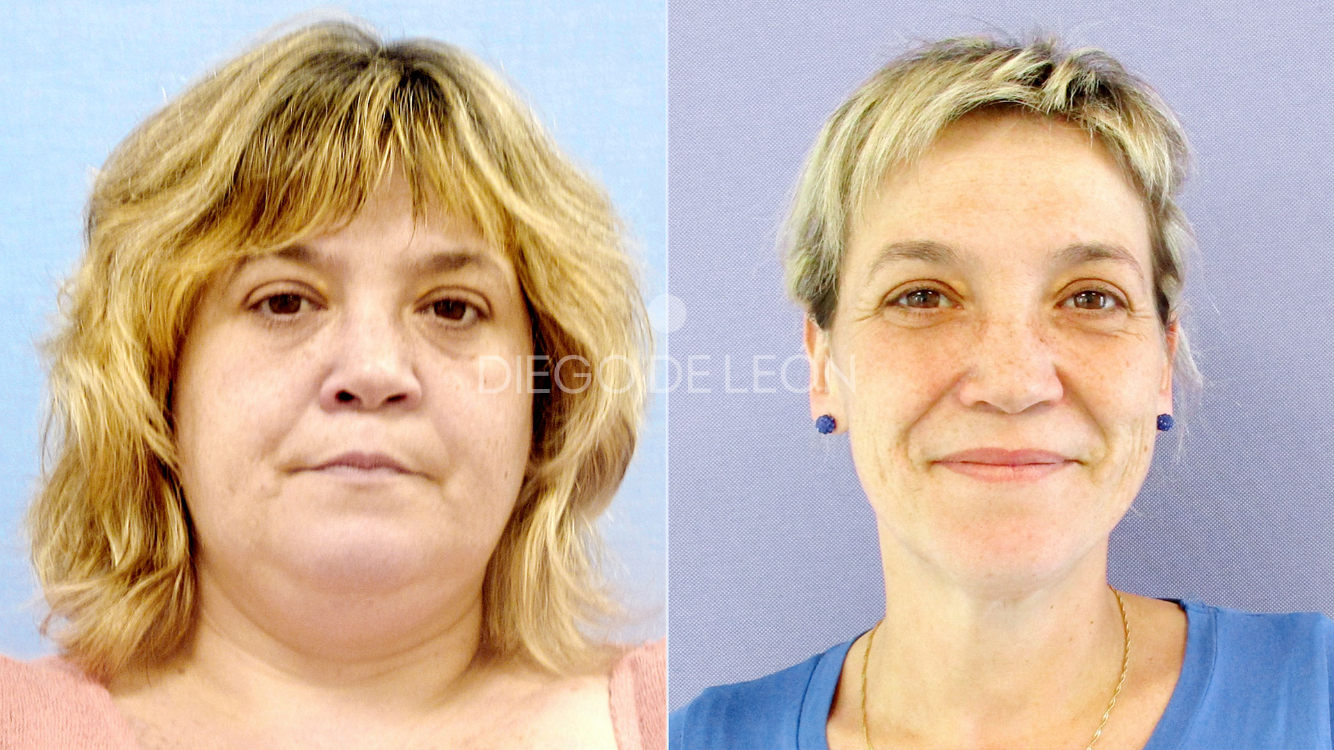 Reducción de estómago con manga gástrica: testimonio de Sonia