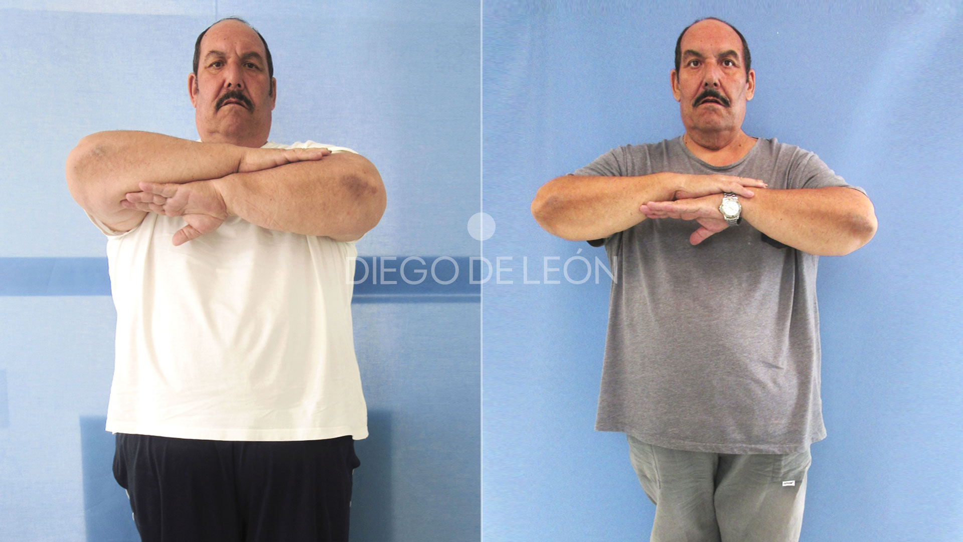 Bypass Gástrico: la increíble historia de la familia Plaza