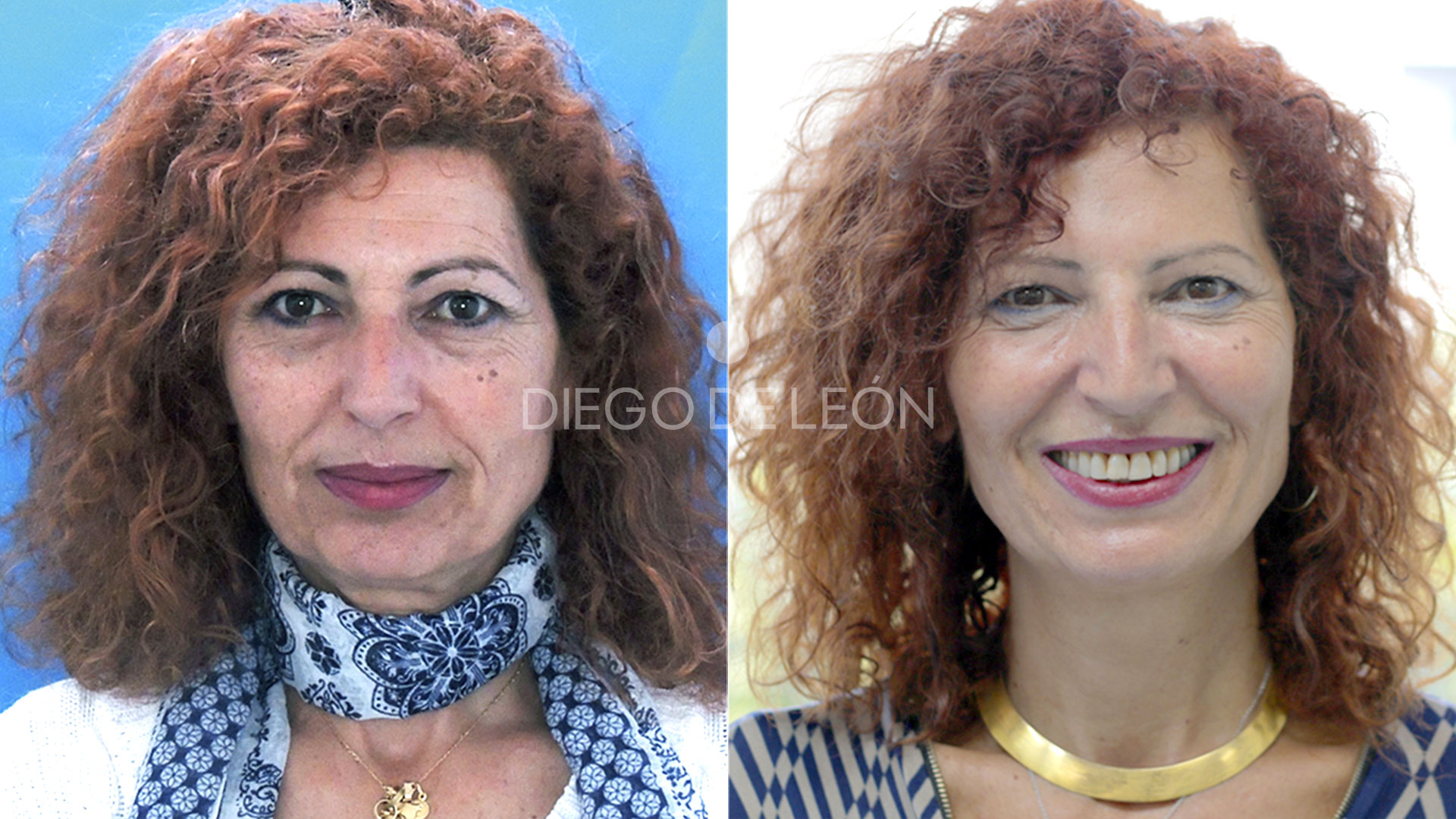 Rejuvenecimiento Facial Completo: Testimonio