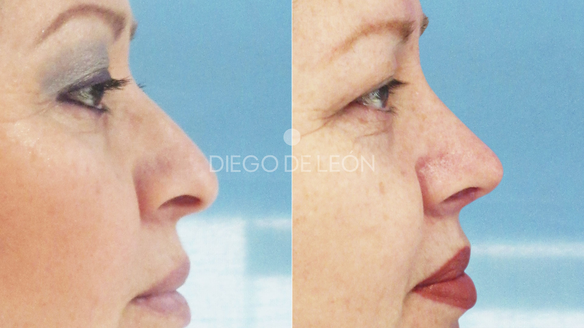 Levantar Punta de la Nariz | Testimonio Rinoplastia