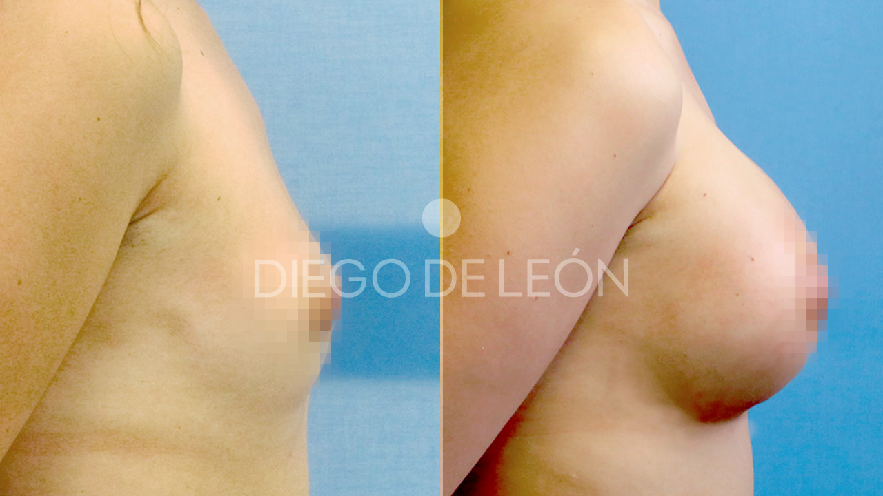 Opiniones Aumento de Pecho