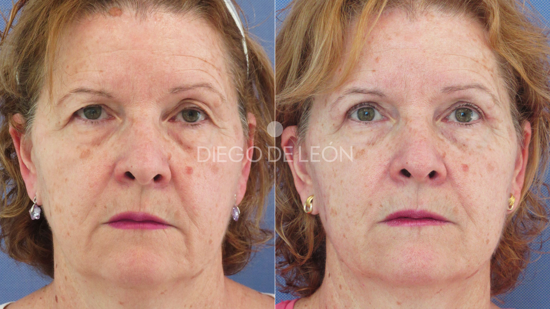 Eliminación de grasa de los párpados superiores | Testimonio