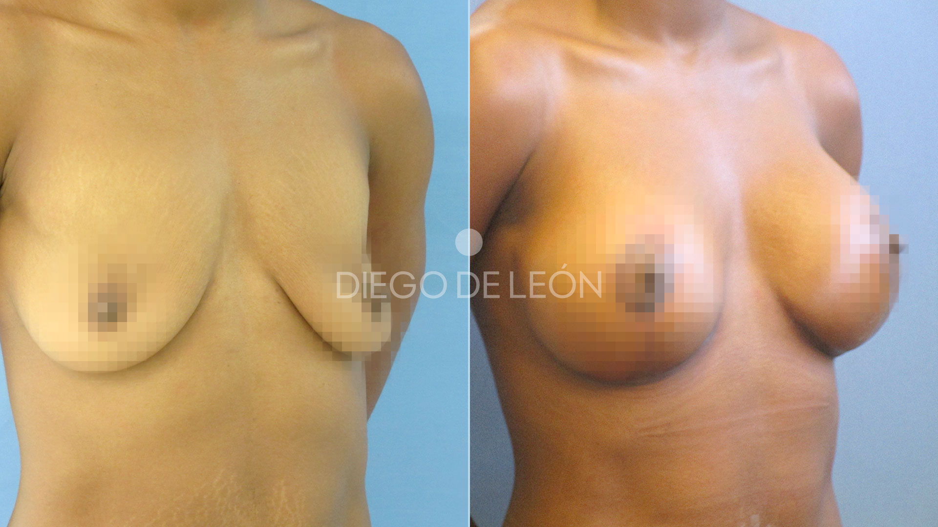 Mastopexia con implantes | Testimonio