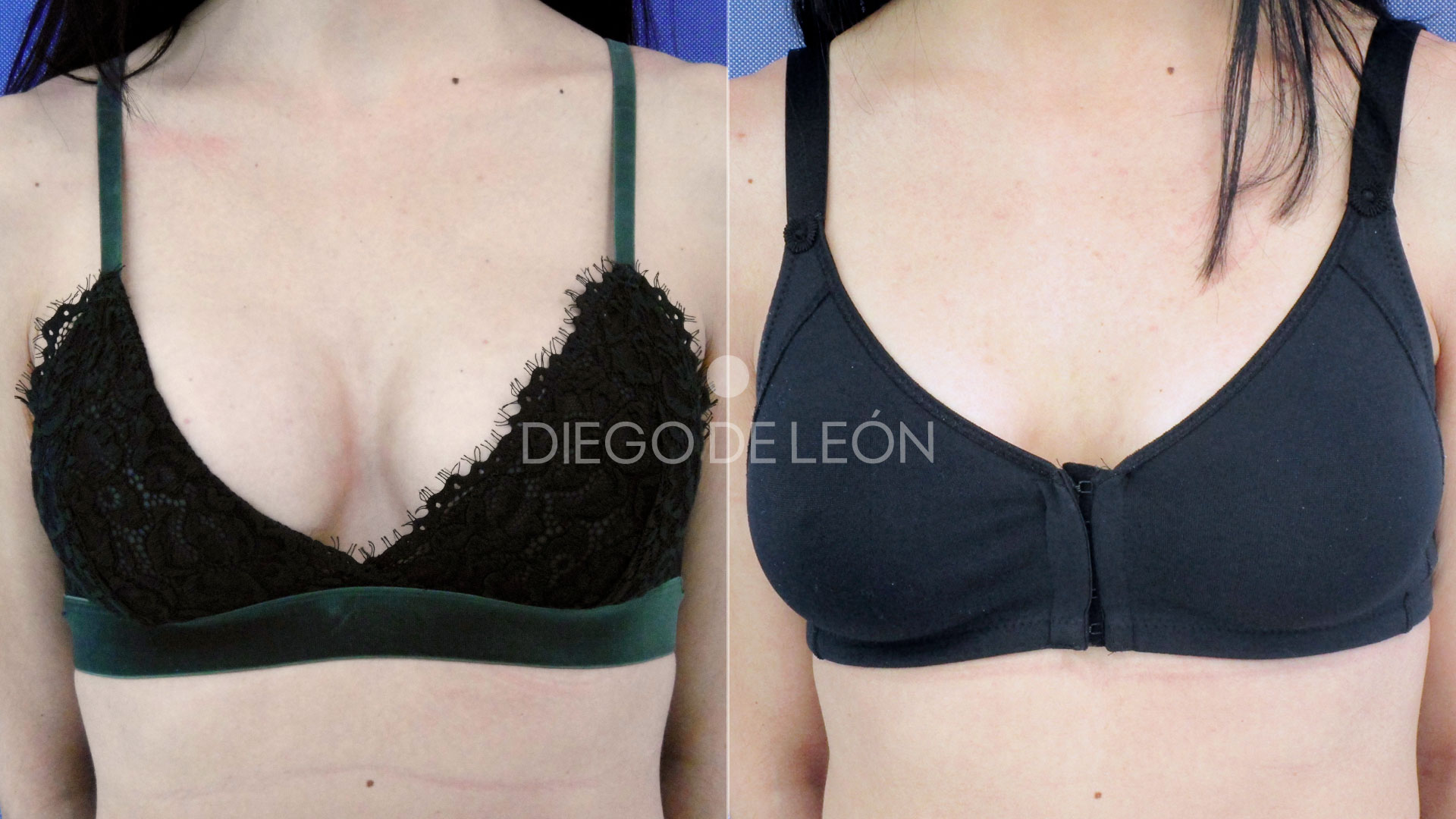 Recambio de Prótesis | Testimonio