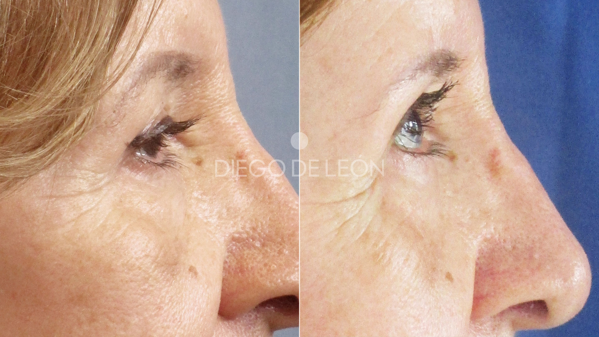 Testimonio Blefaroplastia Superior: mejora de la visión