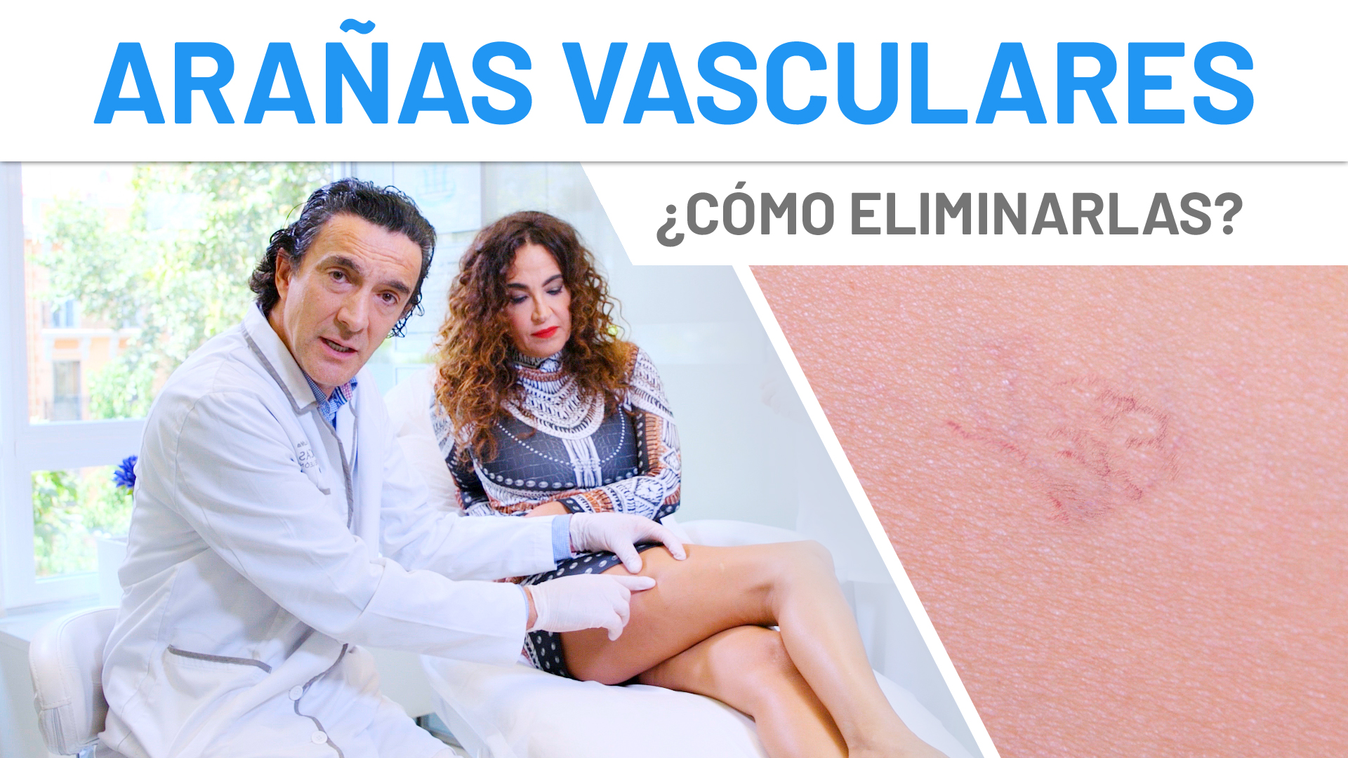 Cristina Rodríguez elimina sus Arañas Vasculares