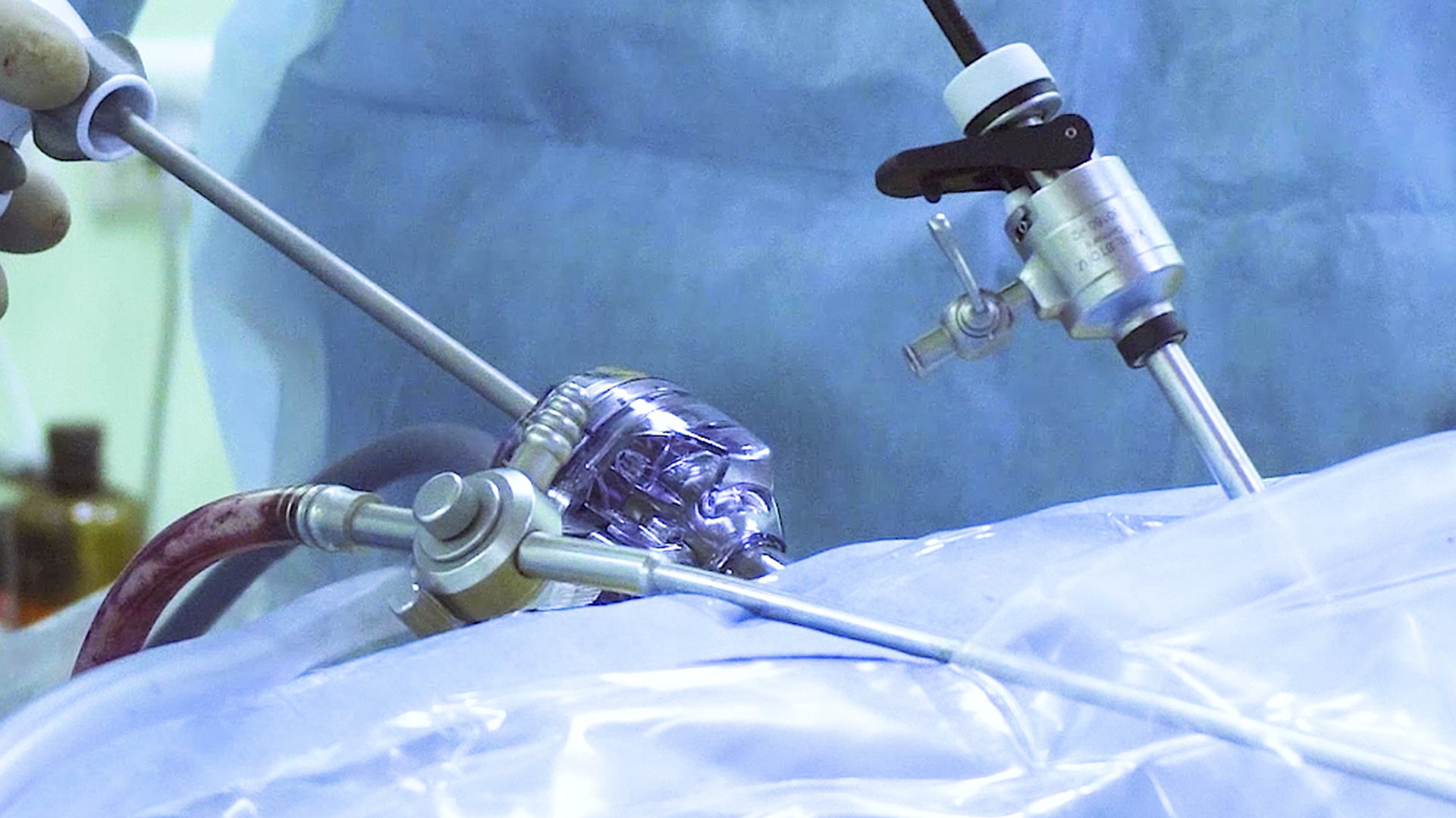 ¿Cómo se hace la Manga Gástrica? [Reduce la capacidad de tu ESTÓMAGO un 80%]