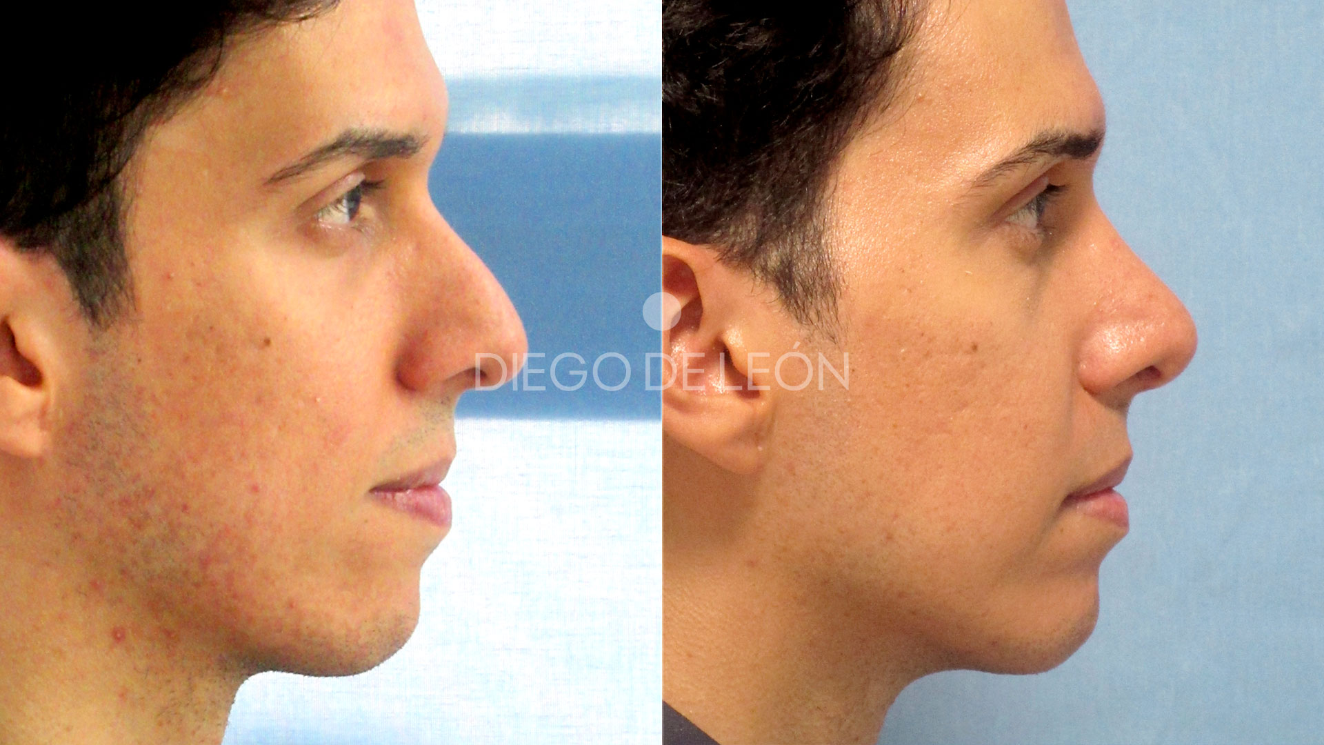 Rinoseptoplastia Masculina