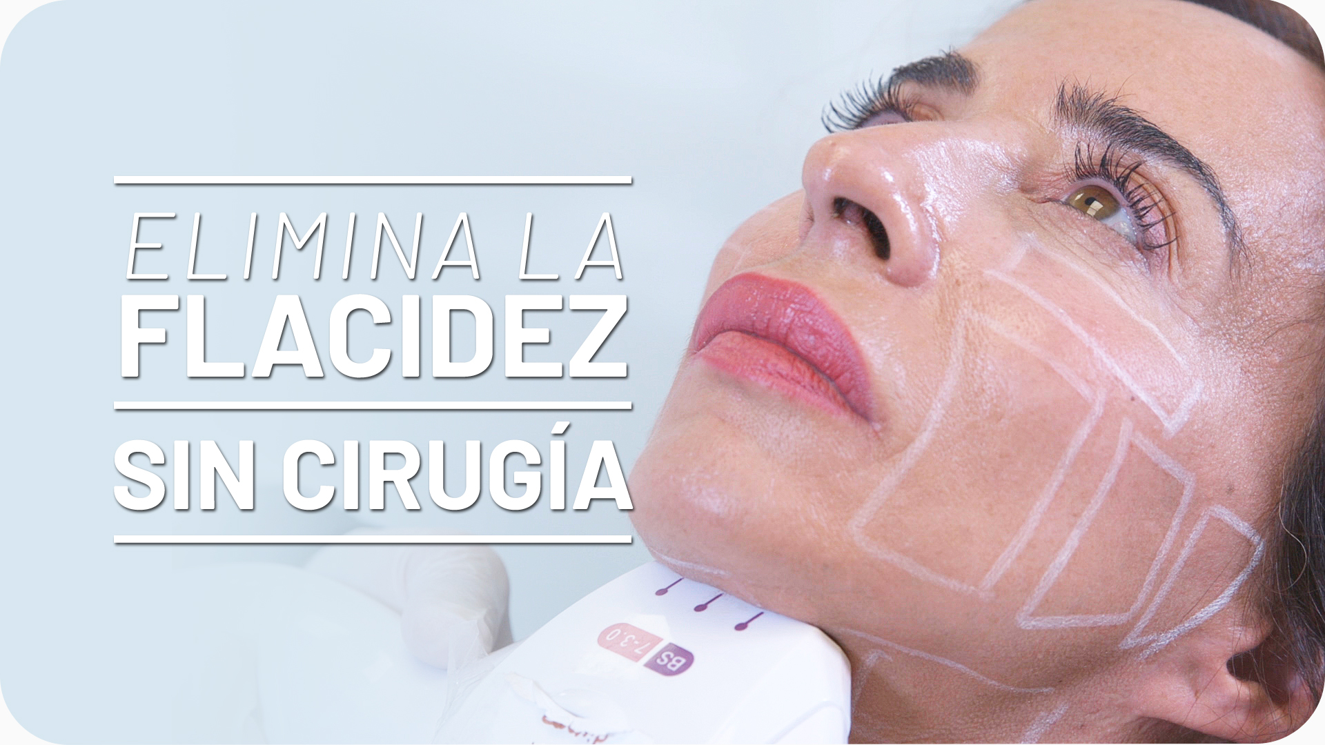 María Patiño elimina papada con Ultrasonidos HIFU [Vídeo]