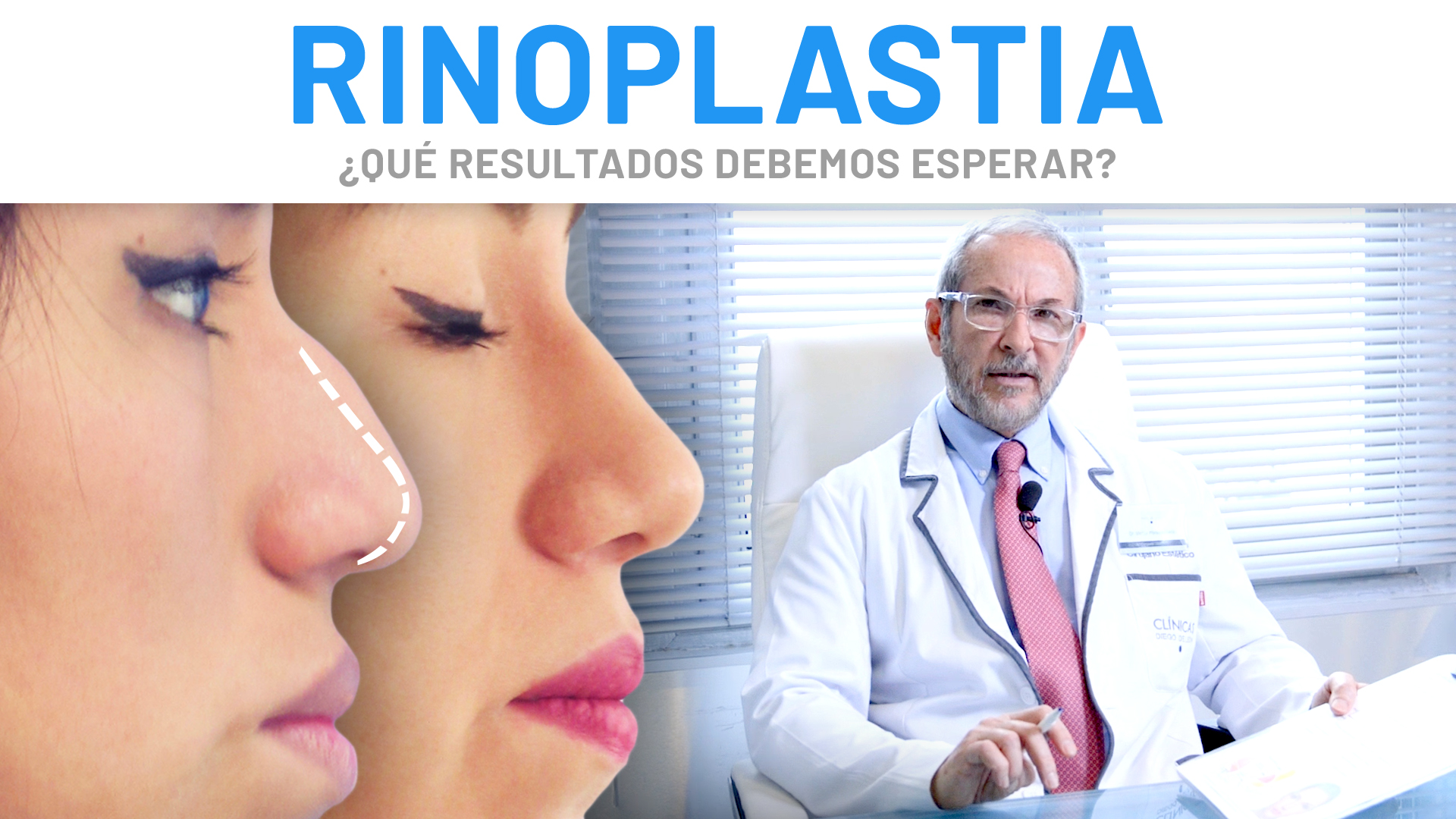 Rinoplastia |  Explicación y Resultados