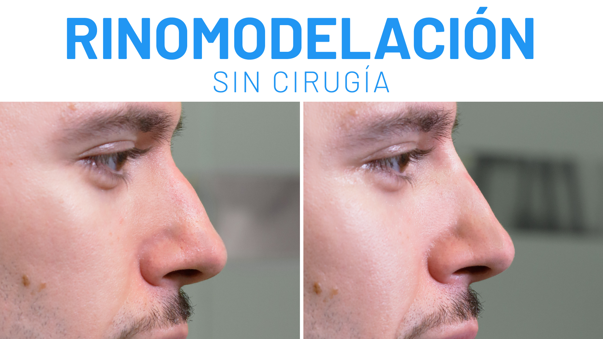 Junior Ferbelles se hace una Rinomodelación en Clínicas Diego de León