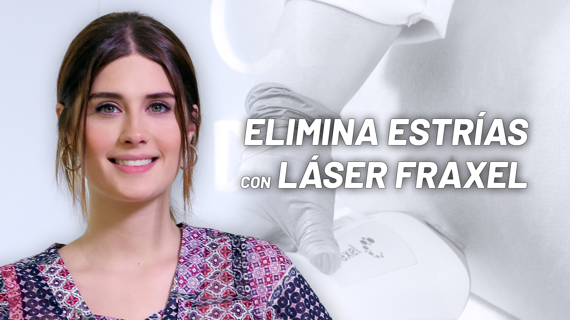 Nerea Camacho confía en el Láser para Eliminar Estrías