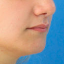 Aumento de labios permanente