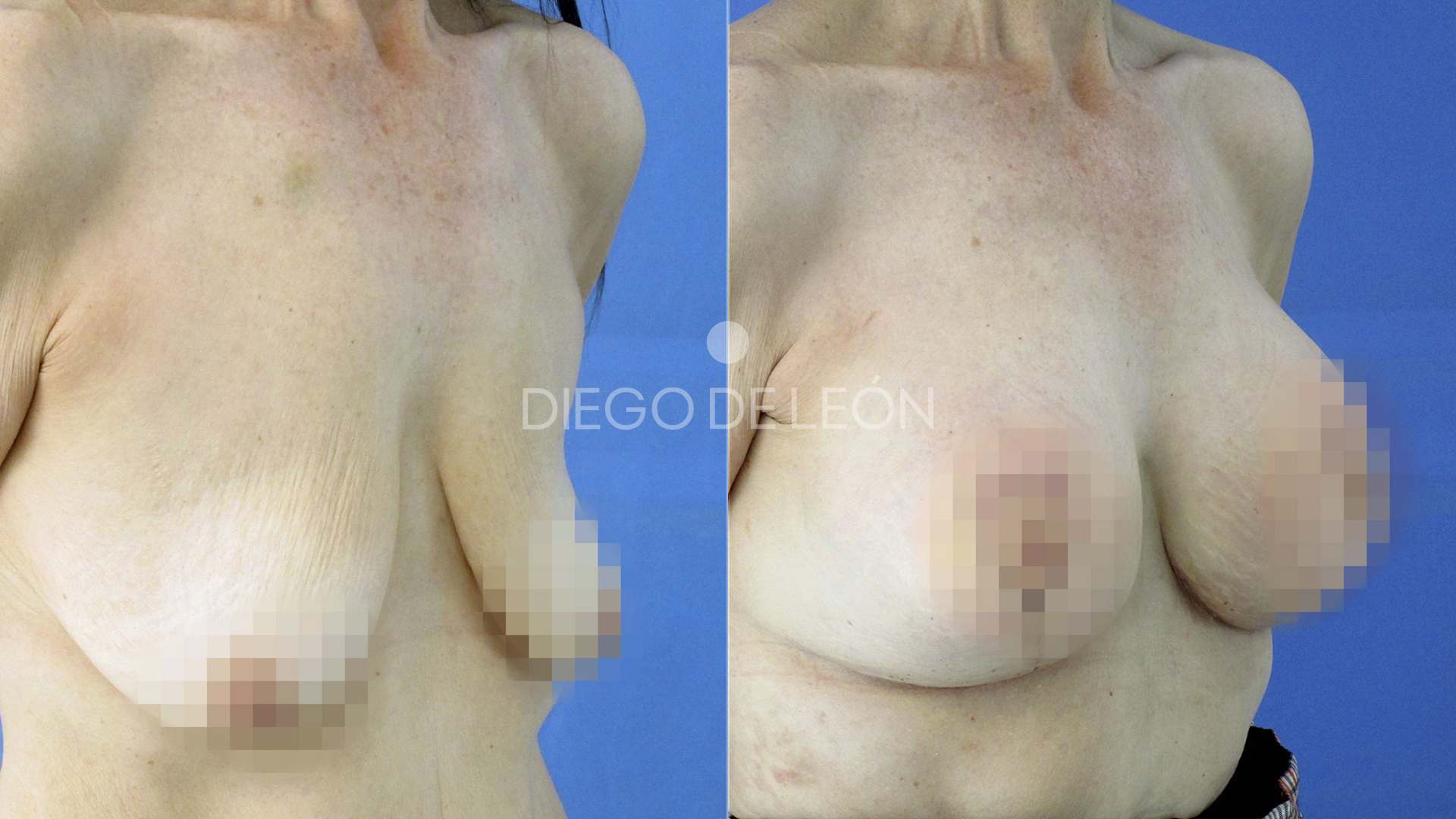 Testimonio – Mastopexia con Prótesis