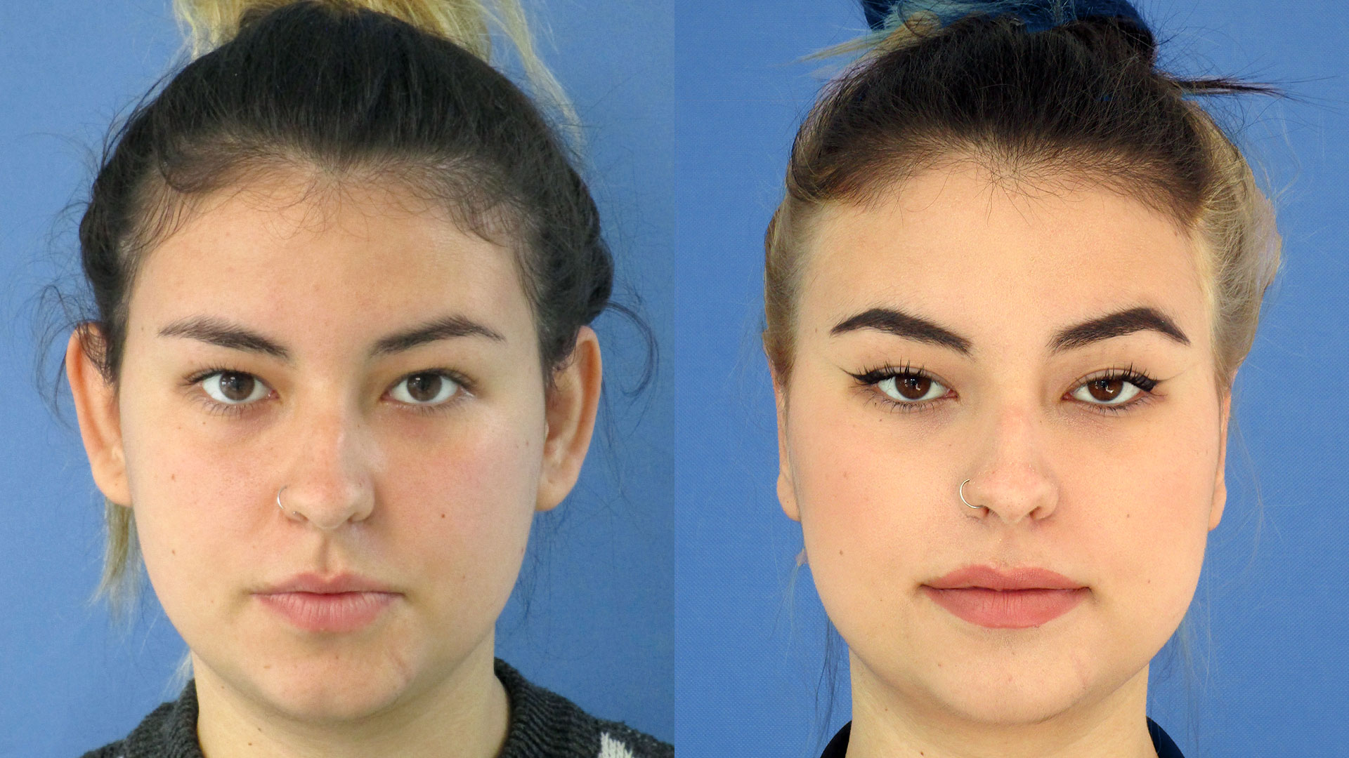 La otoplastia de Cristina: “Ahora me siento más segura de mí misma”