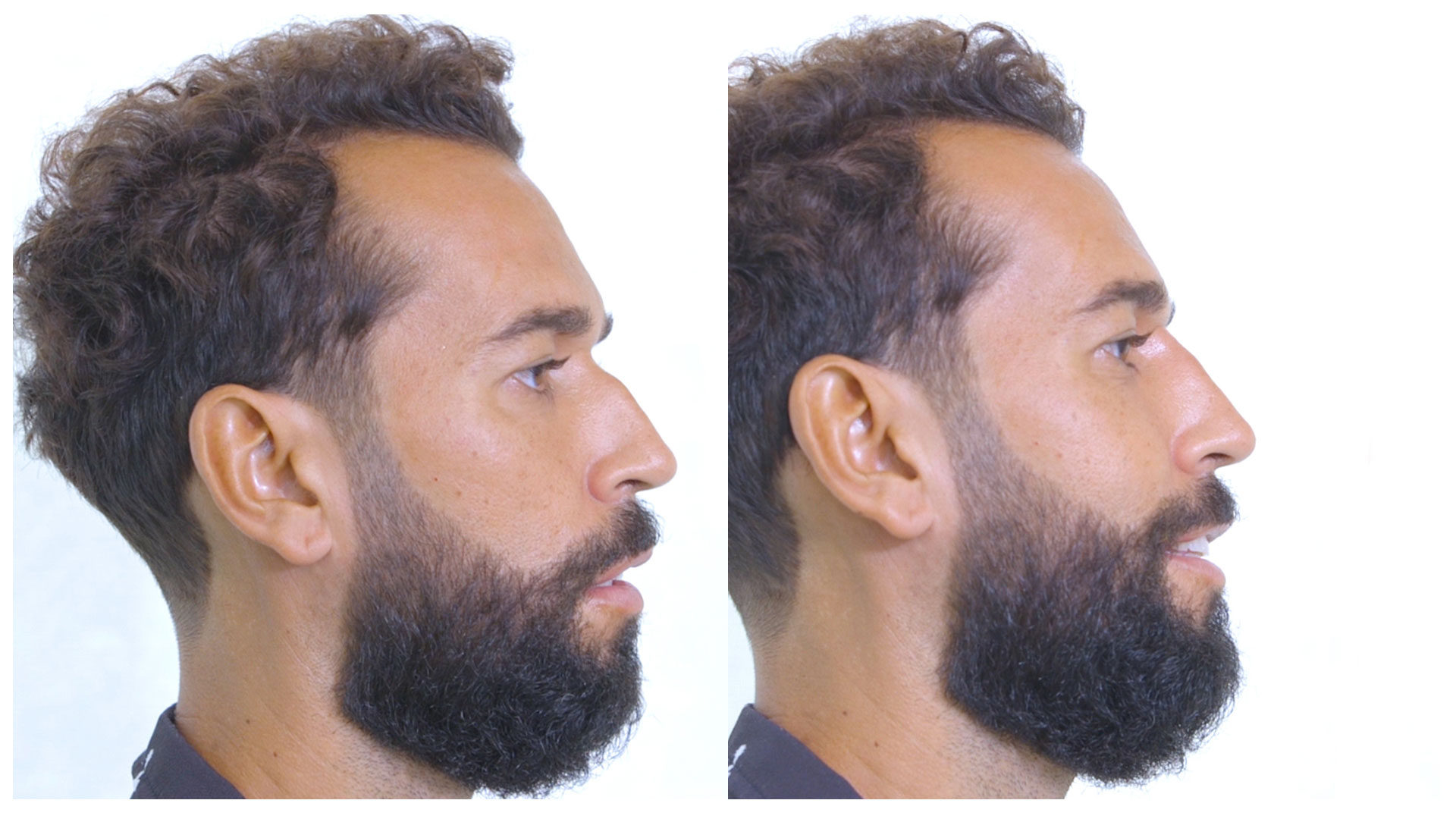 Omar Sánchez se retoca la nariz antes de su boda: ¡Perfil extra recto!