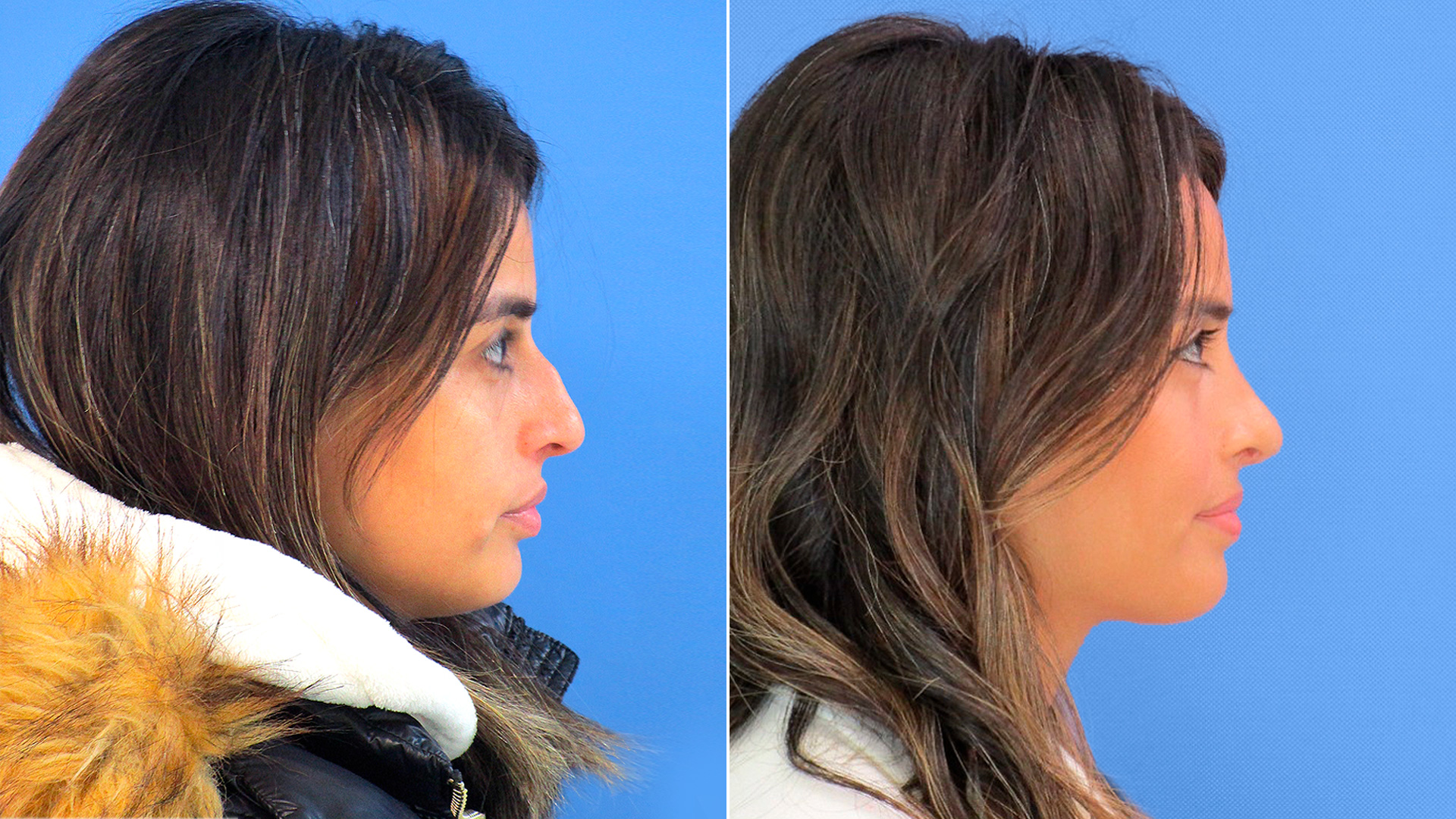 #SinFiltros: Así es el proceso quirúrgico de una rinoplastia