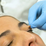 Blefaroplastia Sin Cirugía