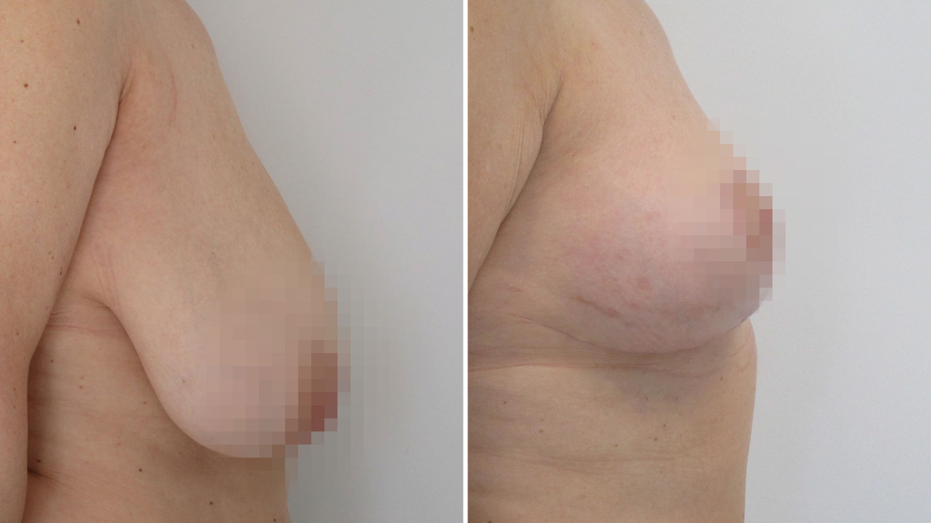 Flavia: “He ganado en calidad de vida; me siento más joven y han desaparecido mis problemas cervicales”