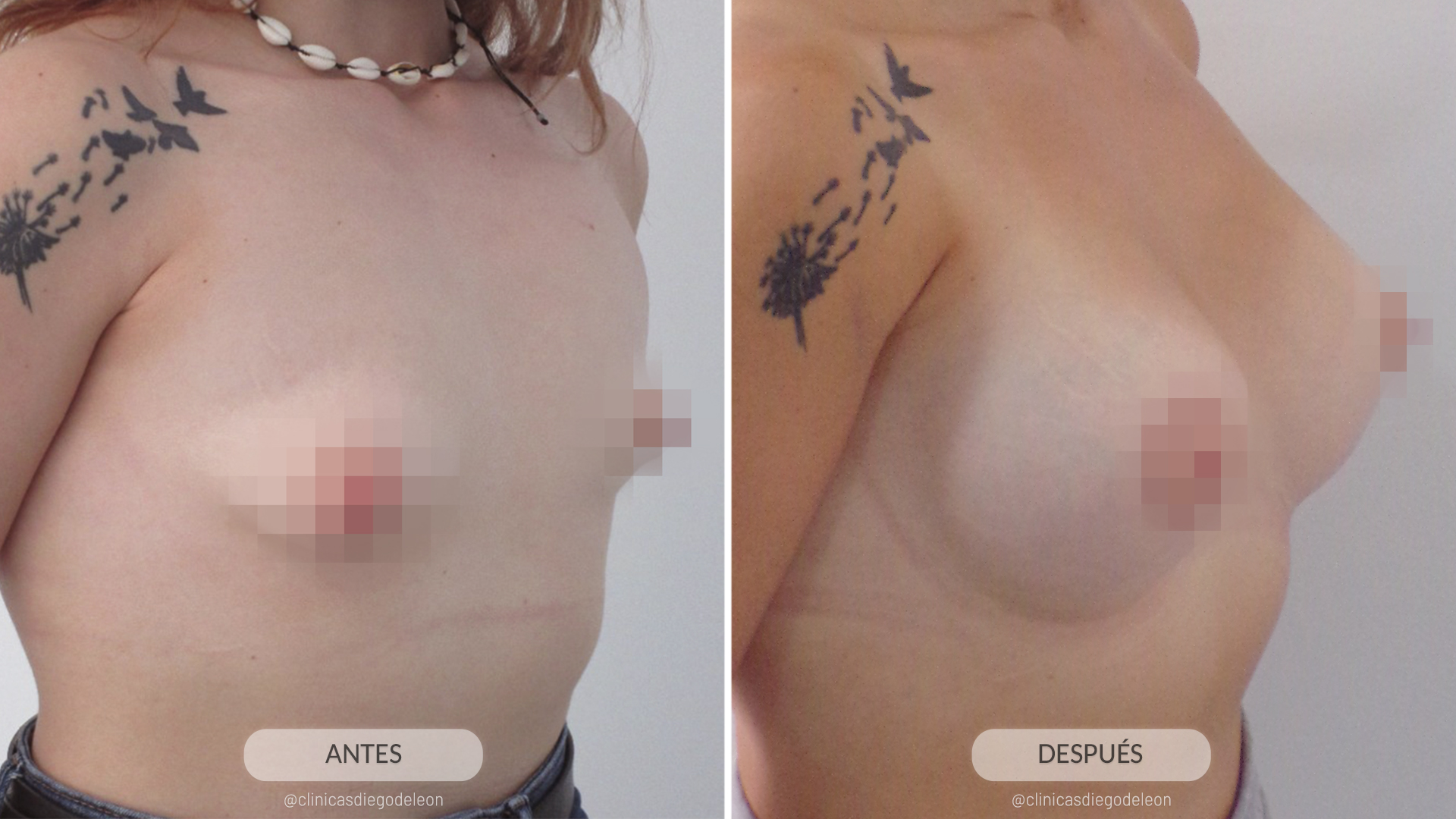 Sheila: “Mi mastopexia es una obra de arte”