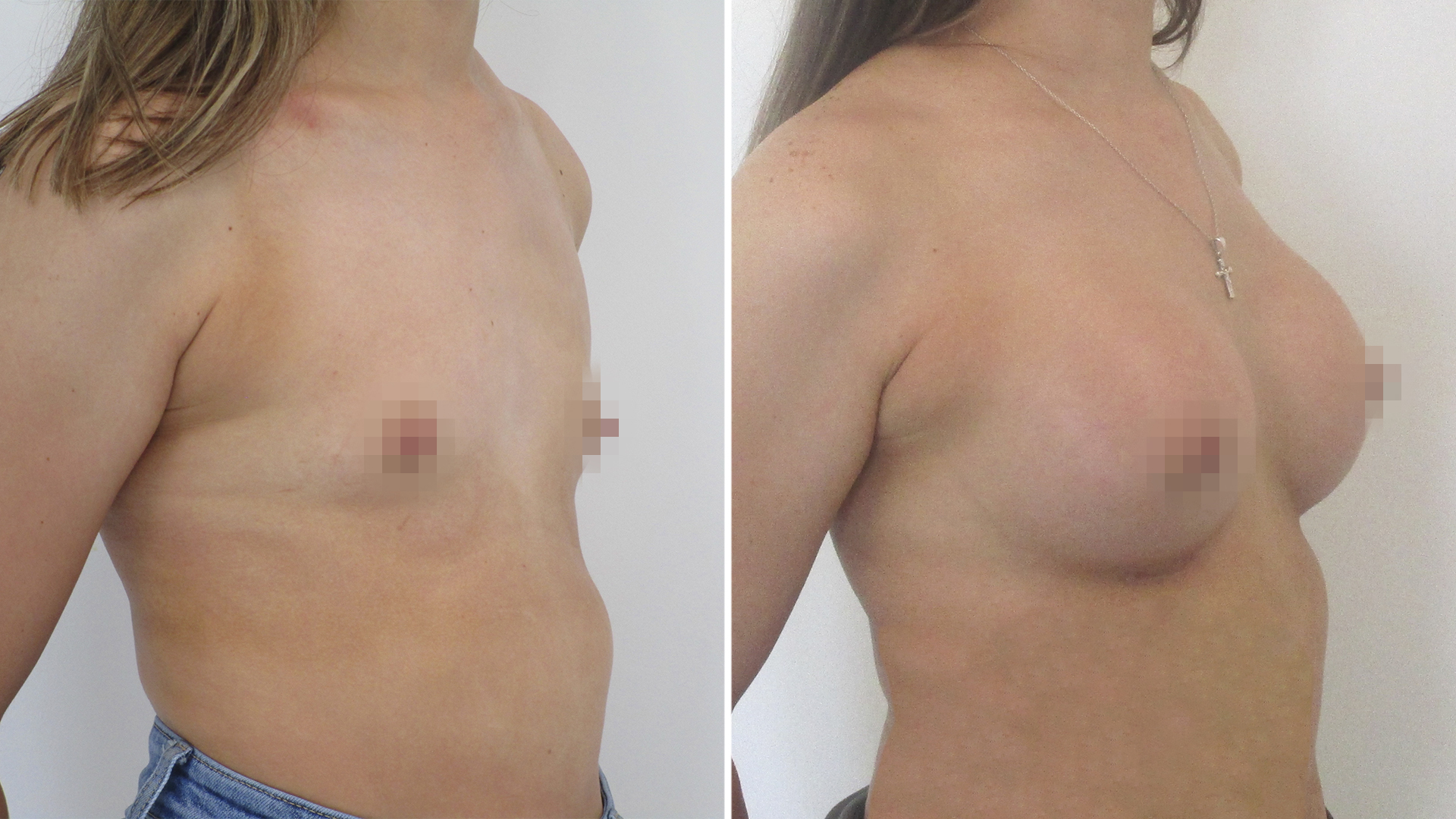 Vanesa tras su aumento de pecho: “Mi autoestima se ha disparado al 100%”