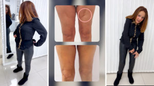 Soledad: ¡Desde que remodelé mis piernas ya no uso medias!