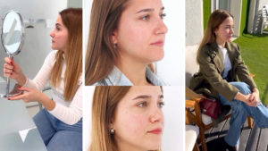 Miriam: “Antes de mi rinoplastia no soportaba que me mirasen cuando estaba de perfil”