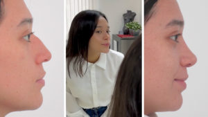 Nicole: Me siento más segura de mí misma tras la rinoplastia