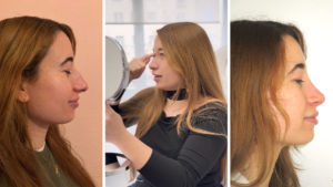 María tras su rinoplastia: Por fin vuelvo a respirar bien y me reconozco frente al espejo