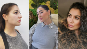 Beatriz: “Antes me asfixiaba haciendo deporte y la punta de la nariz caía al sonreir”